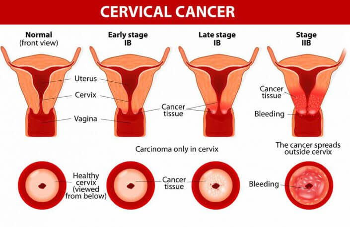 Fases do câncer de colo de útero
